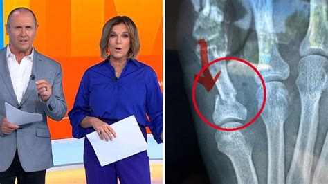 kylie gillies foot injury.